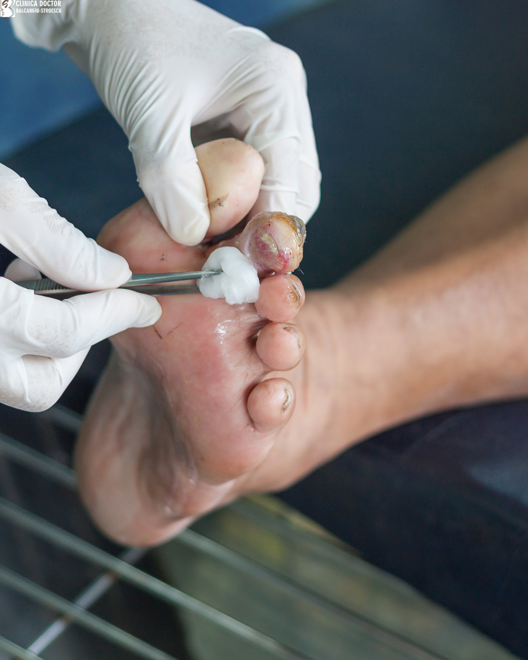 Infecții cutanate la pacienții cu diabet