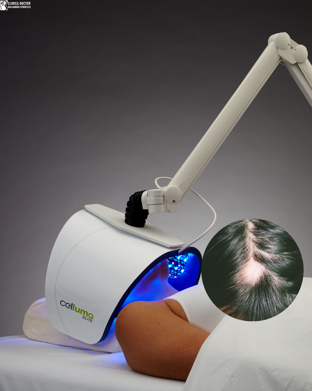 Celluma Red Light Lamp – Post-Rejuvenation Recovery and Alopecia