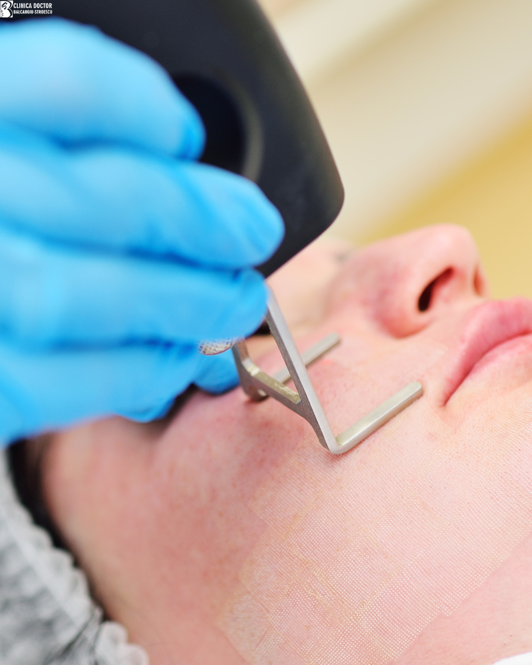 Fractional CO₂ Laser Full Face + Laser Blepharoplasty eyelids+Celluma lamp+PRP