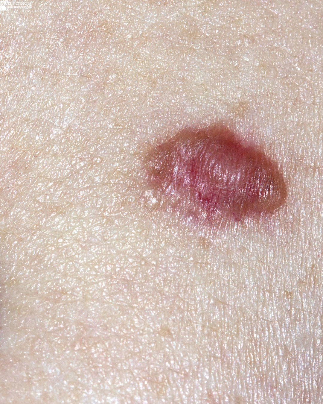 Basal cell carcinoma surgery – primary care physician