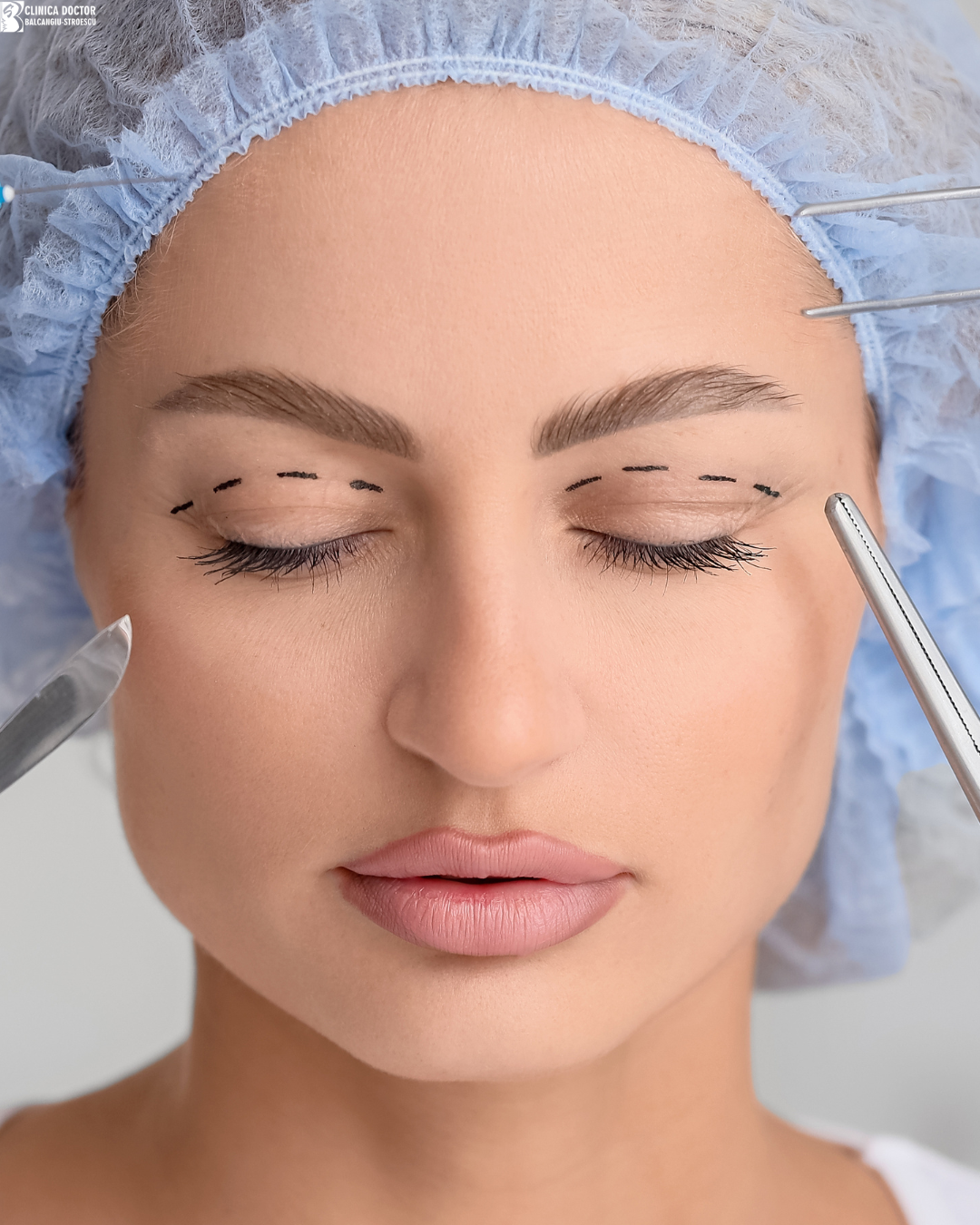 Upper blepharoplasty under local anesthesia - senior physician Upper blepharoplasty under local anesthesia - senior physician