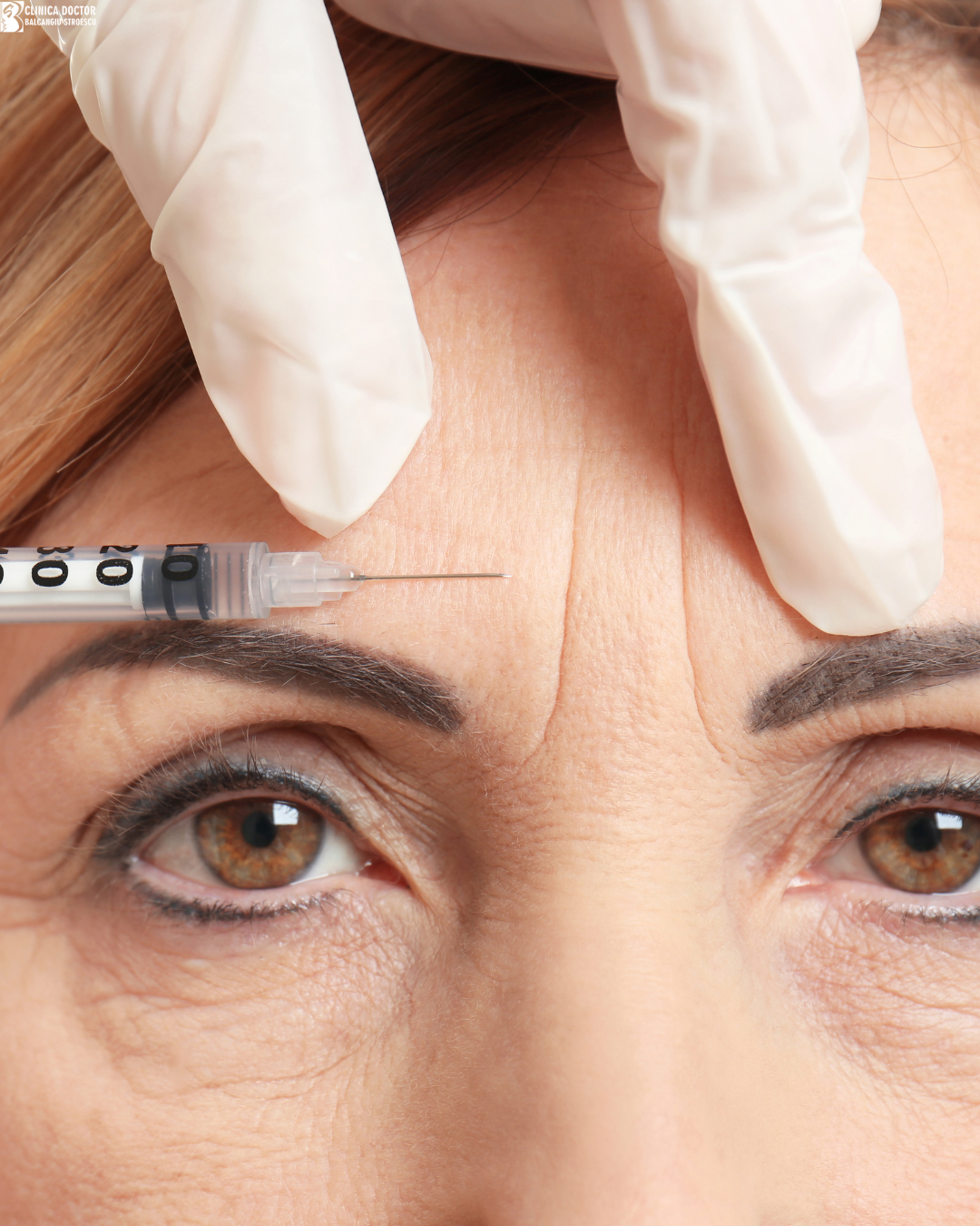 Botulinum toxin - 2 zones