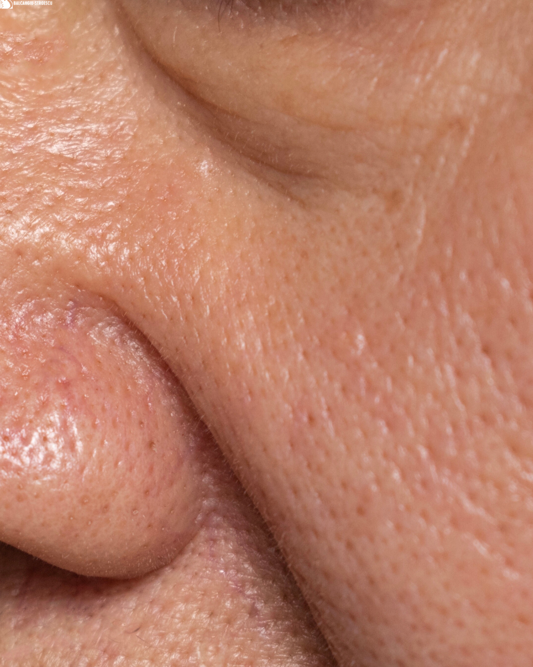 Îndepărtare hiperplazie de glandă sebacee prin fotovaporizare – 1 leziune