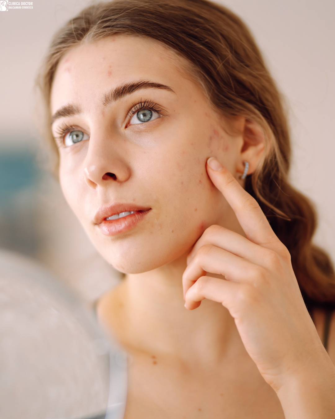 Tratament cicatrici acneice full face (20cm/20cm jumatate din fata)– laser fracționat CO₂ ultrapulsat