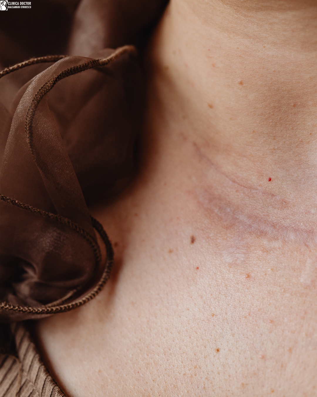 Treatment of hypertrophic and keloid scars with hybrid laser small surface