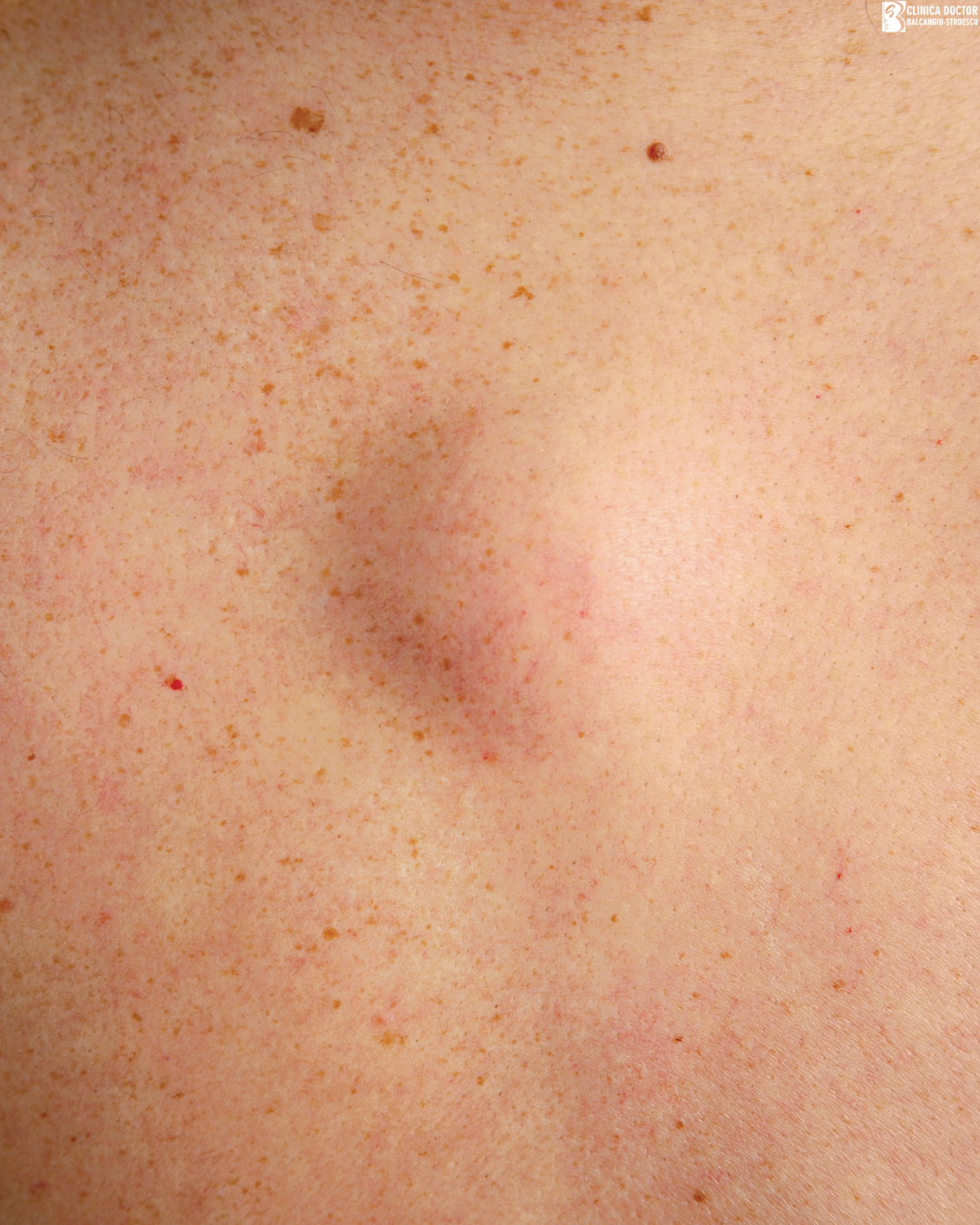 Surgical treatment of 5–7 lipomas in one session
