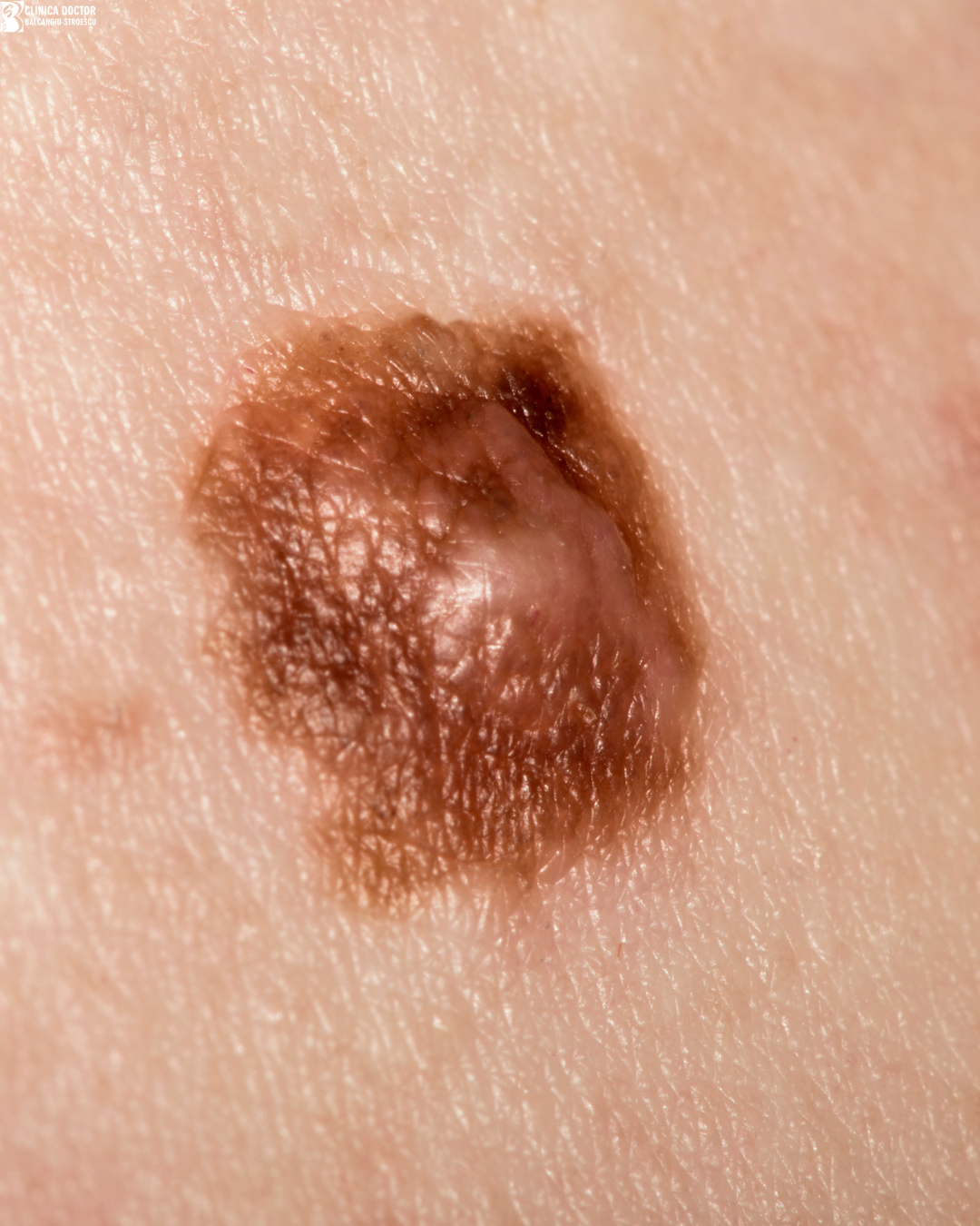 Melanoma excision with safety margin – primary care physician Melanoma excision with safety margin – primary care physician