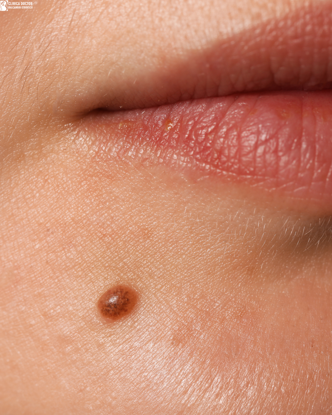 Îndepărtare nev dermal <0,5 cm Îndepărtare nev dermal <0,5 cm