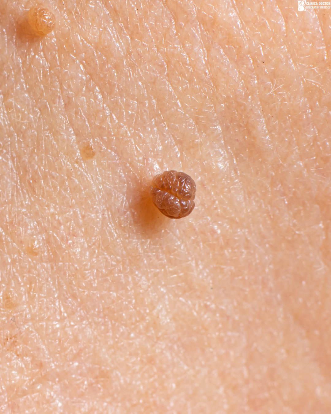 CO₂ laser / plasma papilloma removal – 11–20 lesions