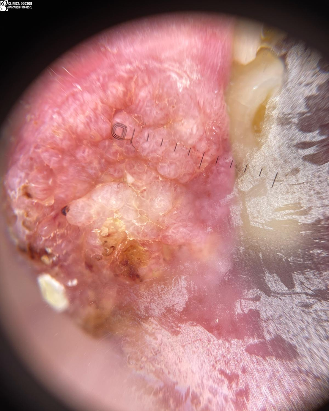 Squamous cell carcinoma surgery – primary care physician