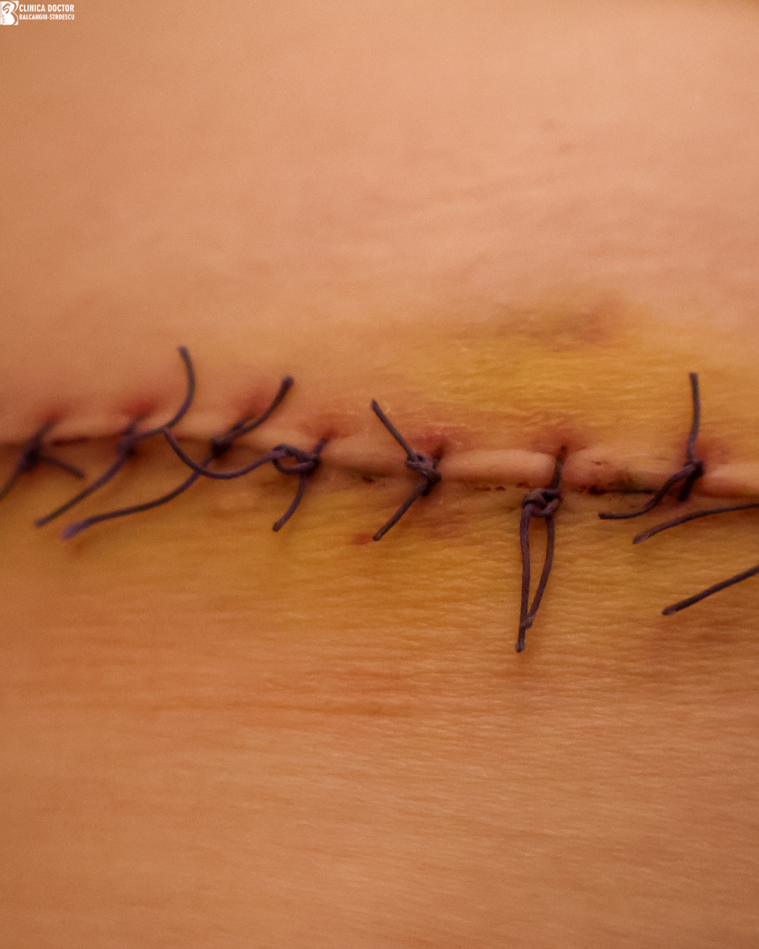 Suture removal (surgical wound)