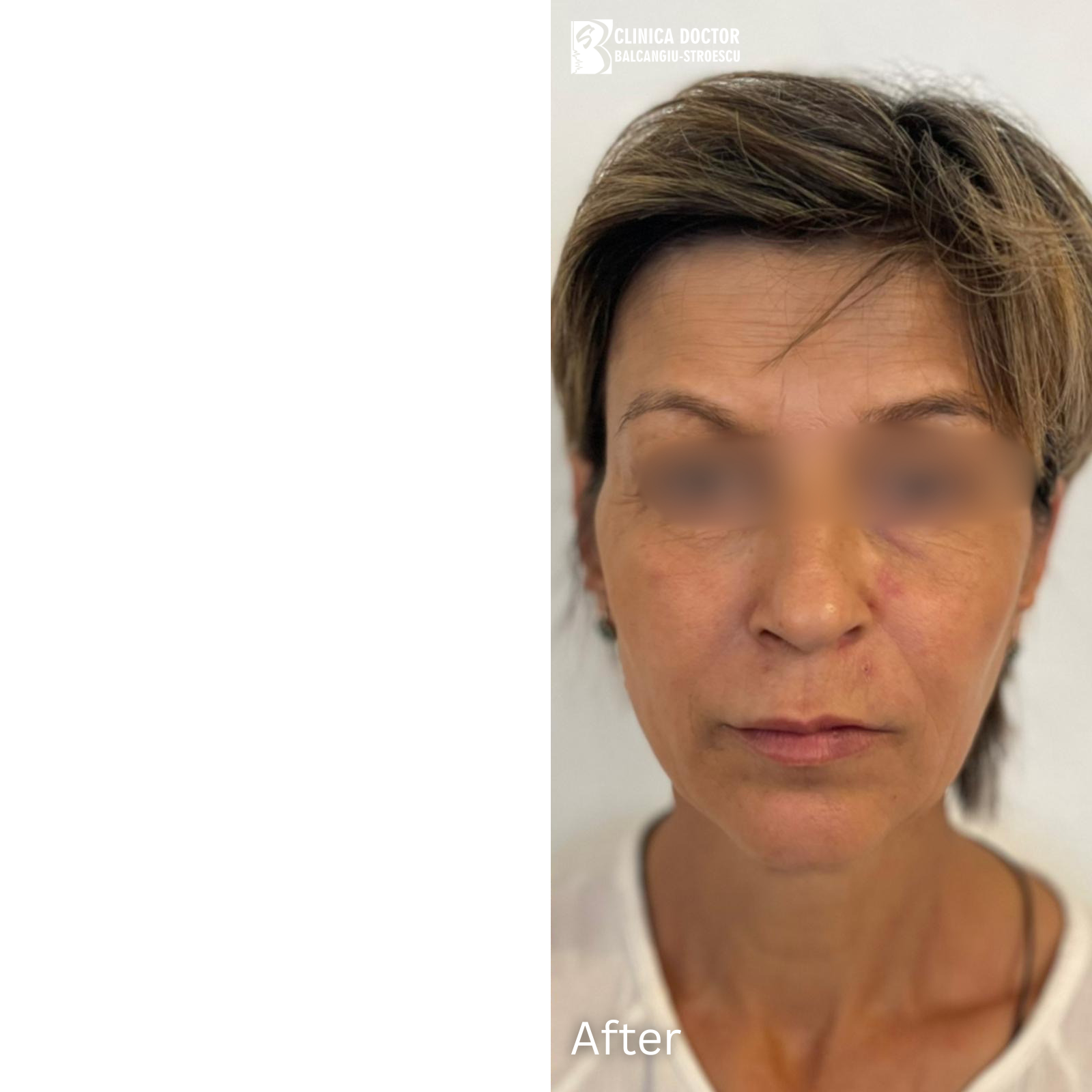 Rejuvenare faciala completa - After