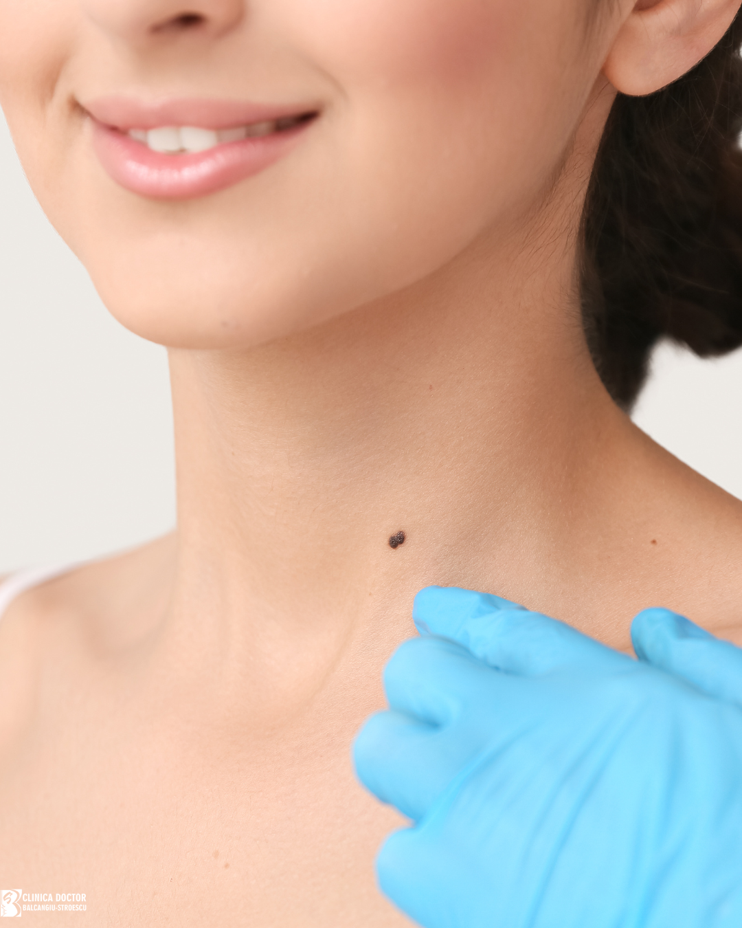 Dangerous Moles – When They Should Be Evaluated by a Dermatologist