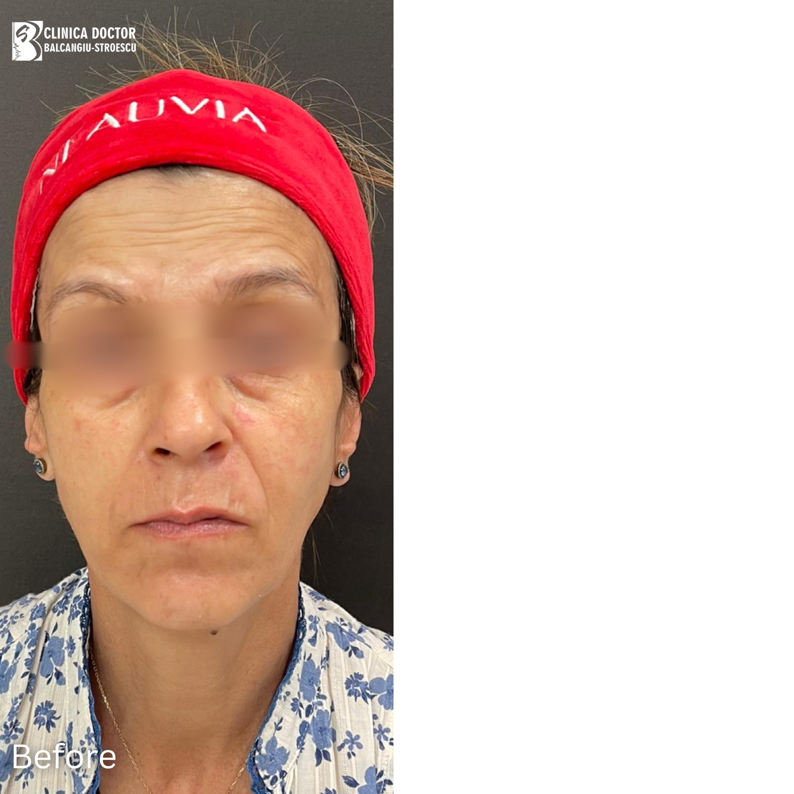Rejuvenare faciala completa - Before