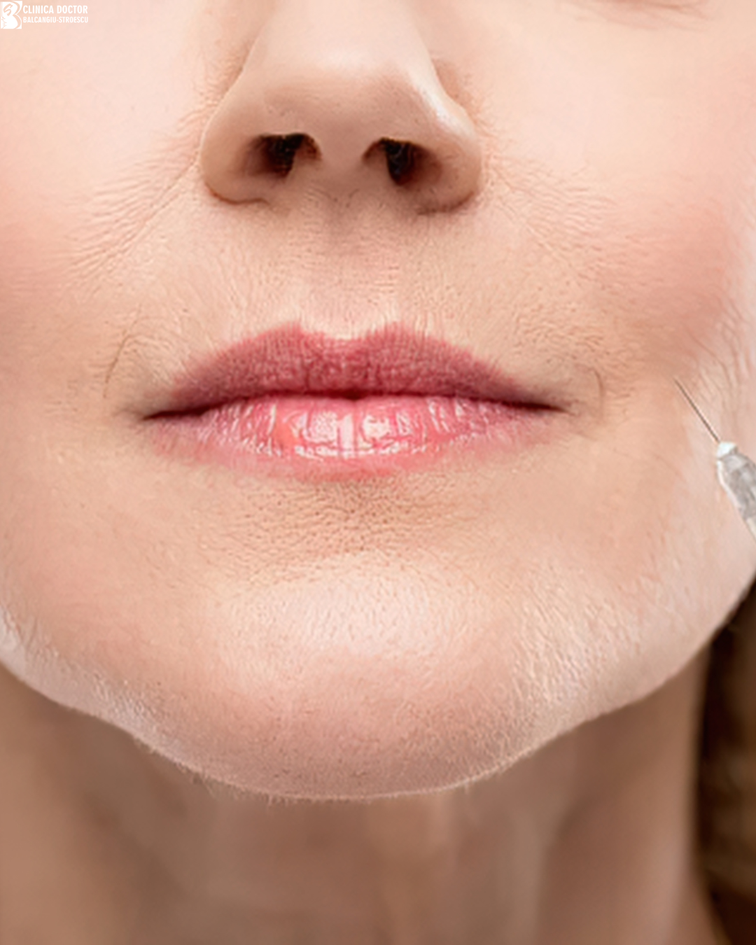 Botox Chin / Smoker Lines / DAO (mouth corners)