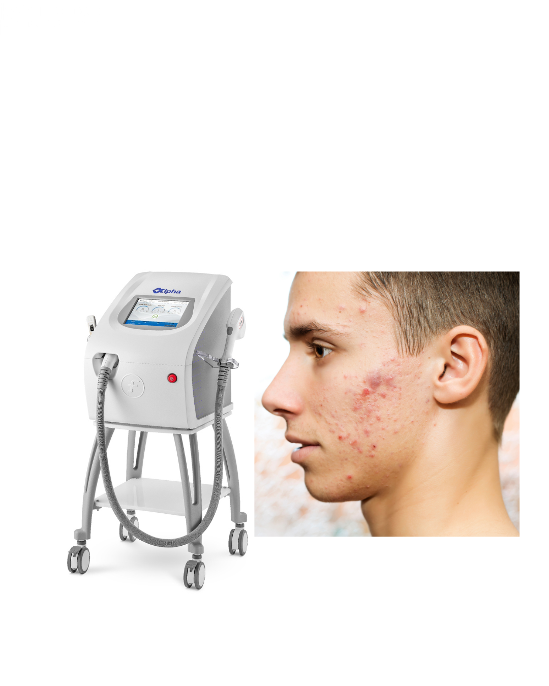 IPL Acne Clear – Active Acne, Seborrheic Skin, Dilated Pores - cheeks/localized area

---