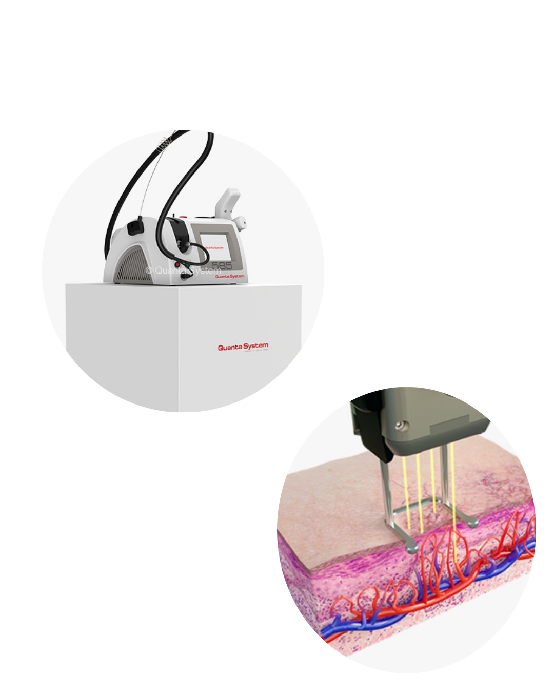 Laser vascular 585 nm by Quanta