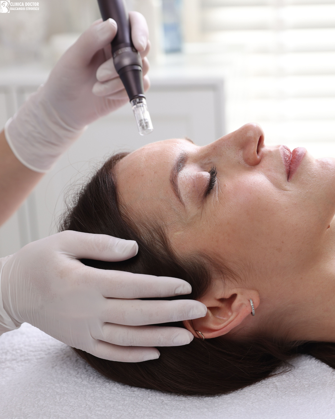 Microneedling Nanopore + PRP – regeneration and post-acne scars