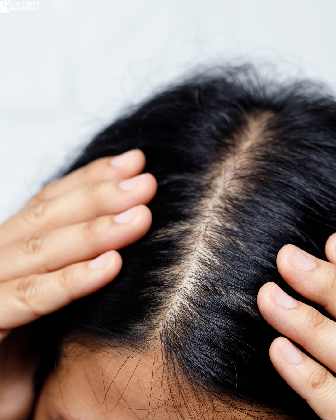 Microneedling Nanopore + exozomi – regenerare avansată și alopecie