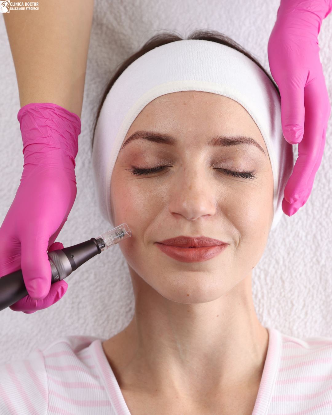 Microneedling Nanopore + mesotherapy – treatment for texture, pores, hyperpigmentation Microneedling Nanopore + mesotherapy – treatment for texture, pores, hyperpigmentation
