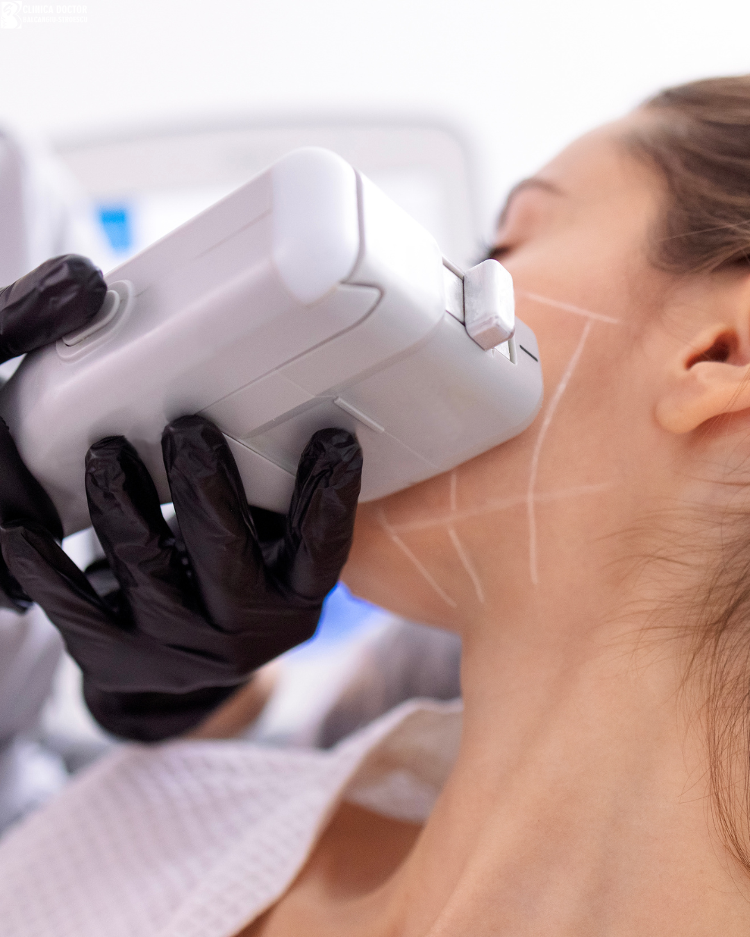 Tratament Liftera/HIFU microfocusat – lifting facial și corporal non-chirurgical - o zonă tratată