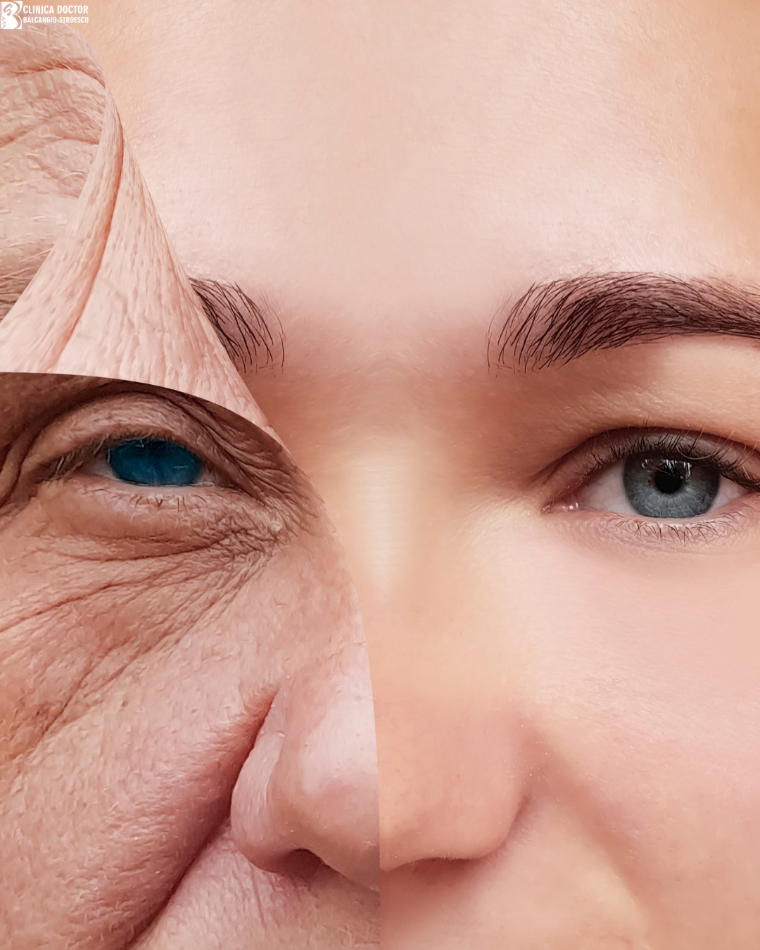 Photoaging Treatment – ClearLift QS Nd:YAG 1064 nm Laser Rejuvenation