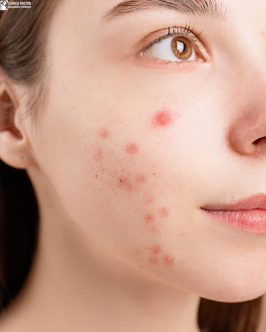 Laser acne treatment for face and neck – Er:Glass 1540 nm