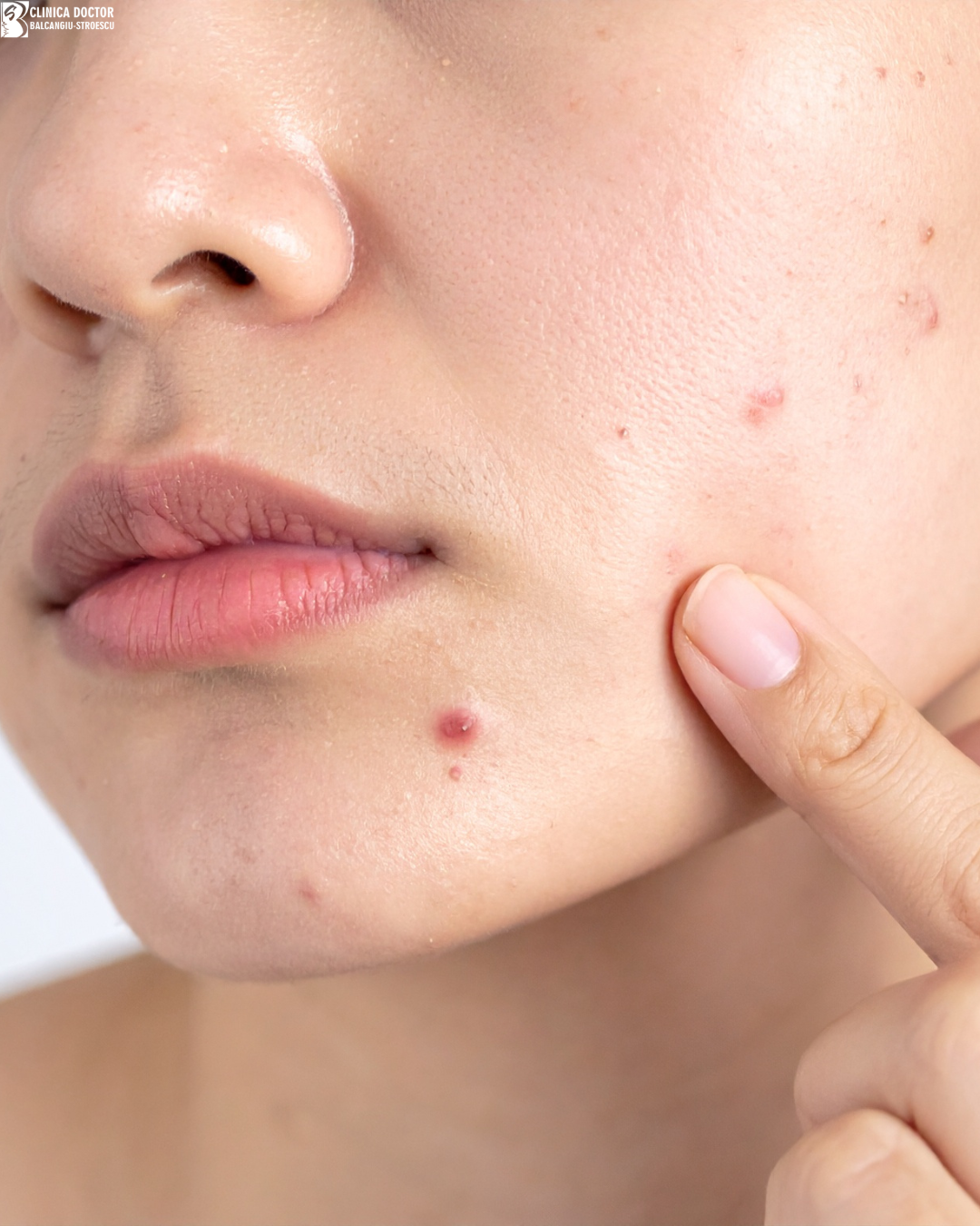 Laser treatment for facial acne – Er:Glass 1540 nm