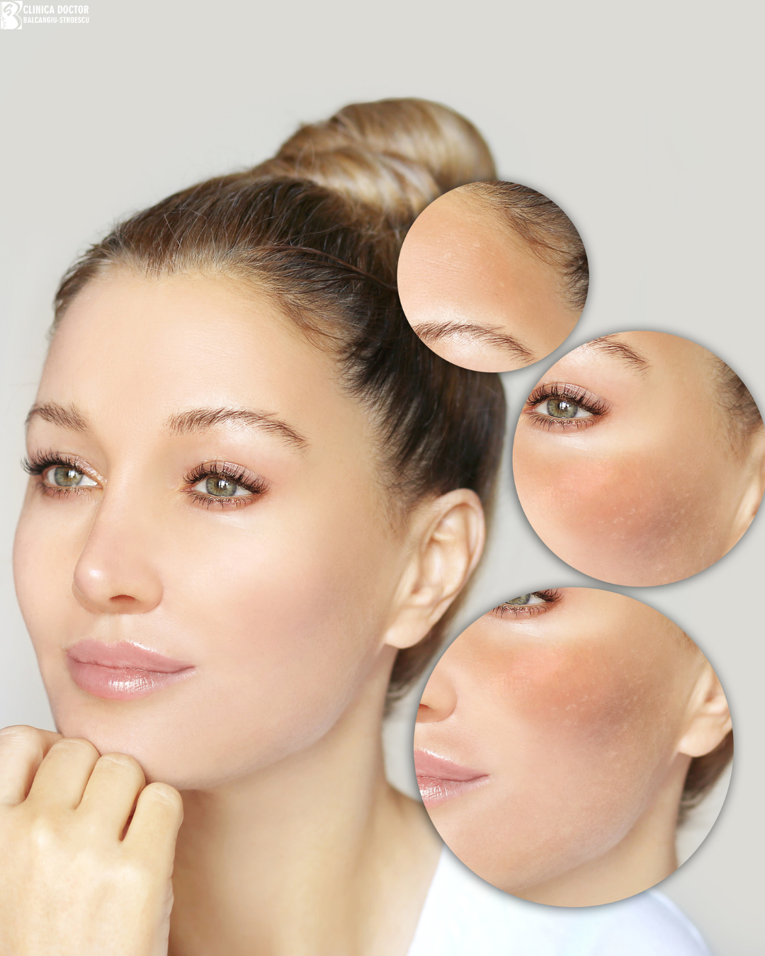 Tratament melasmă – laser ClearLift QS Nd:YAG 1064 nm