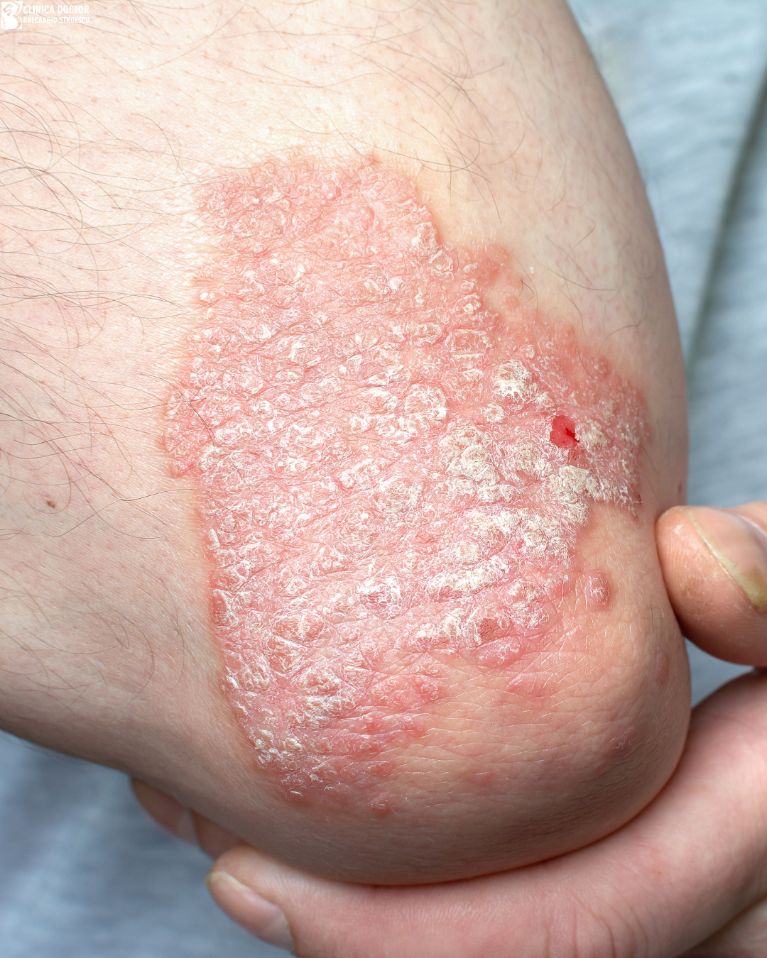 Psoriasis and dermatitis treatment – narrowband UVB phototherapy