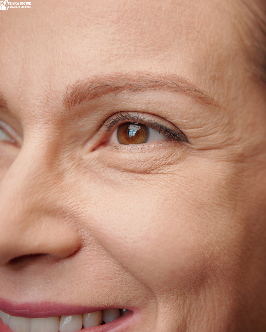 Fine wrinkles treatment – ClearLift QS Nd:YAG 1064 nm (full face)