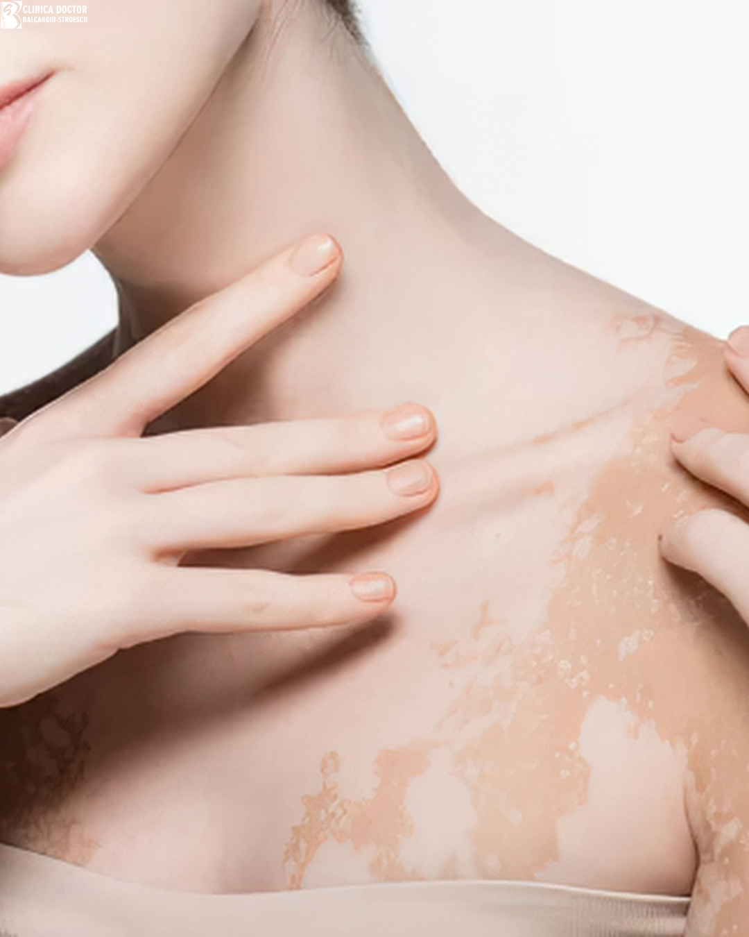 Vitiligo treatment – narrowband UVB phototherapy