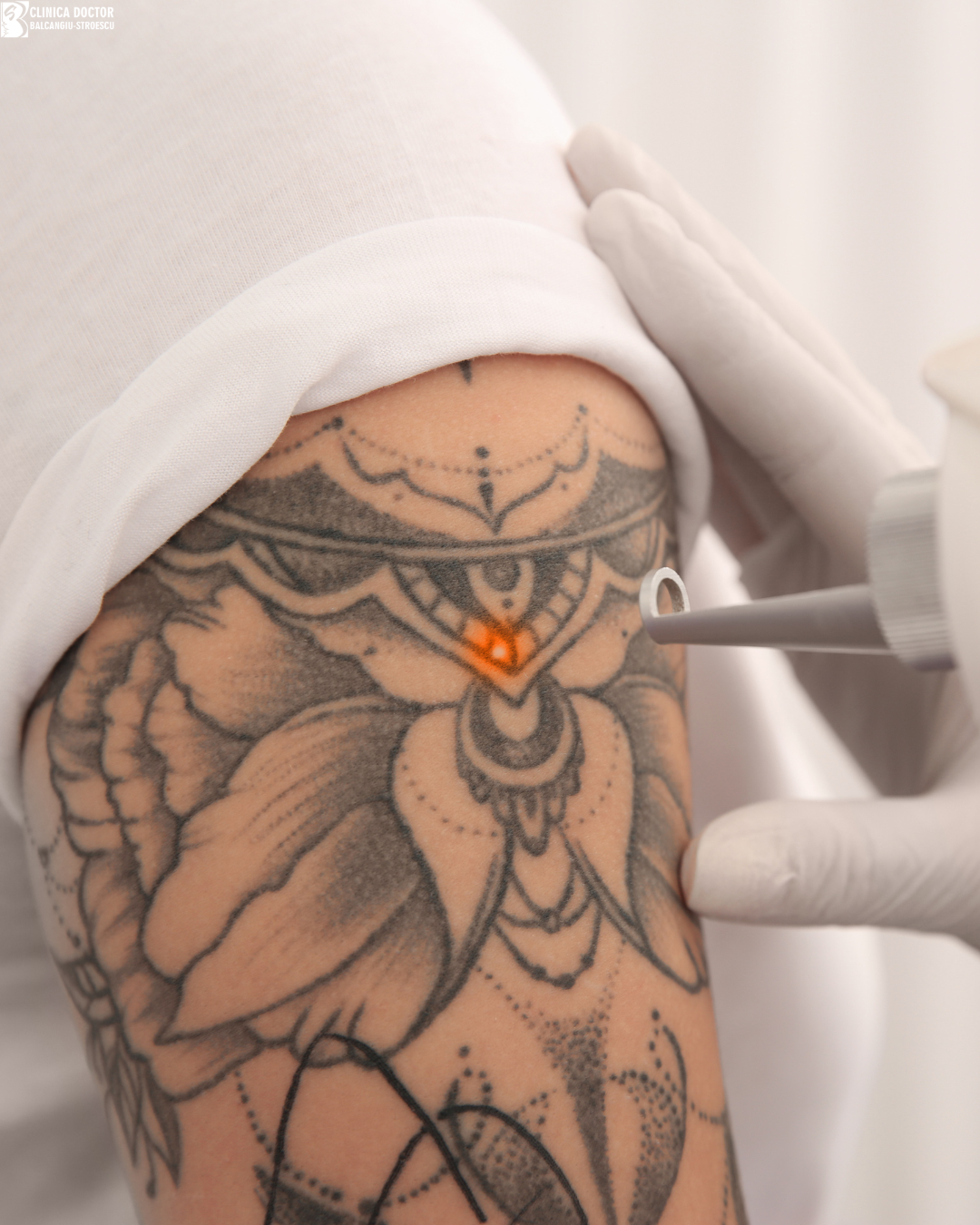 Îndepărtare tatuaj mare – laser ClearLift QS Nd:YAG 1064 nm