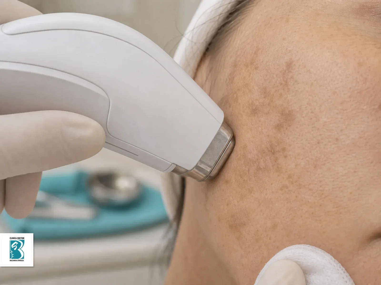 Pete pigmentare si hiperpigmentare - consultatie medic specialist Piesa de tratament laser pozitionata langa pete pigmentare pentru plan medical