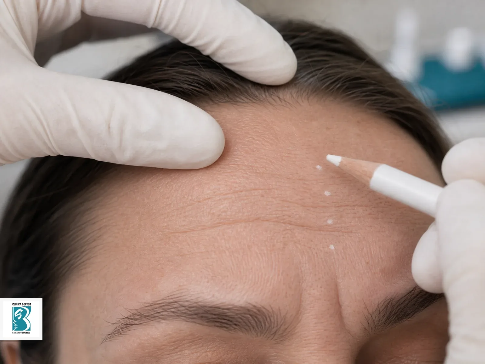 Riduri faciale si riduri de expresie - consultatie medic specialist Marcaj dermatologic pe frunte si glabela pentru planificarea tratamentului ridurilor de expresie