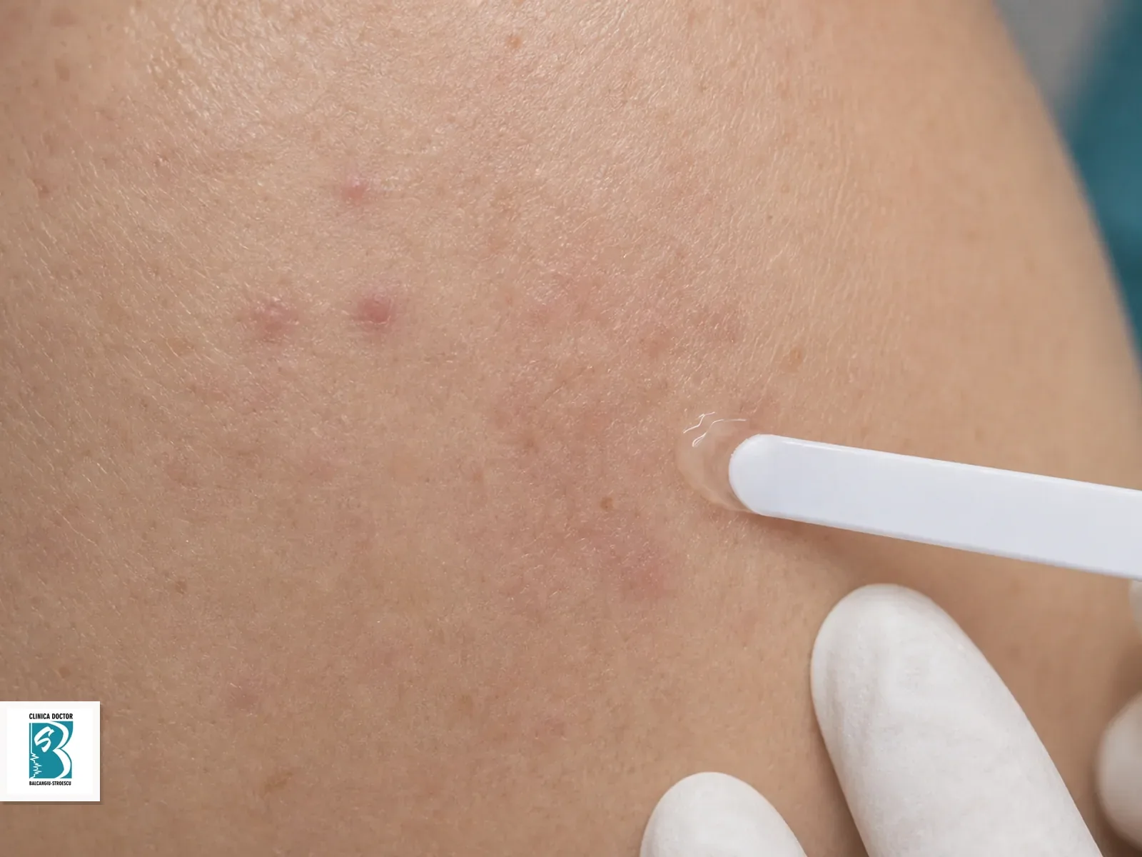 Control medic specialist dermatologie Aplicare de gel dermatologic pe urme post-acneice in cadrul controlului