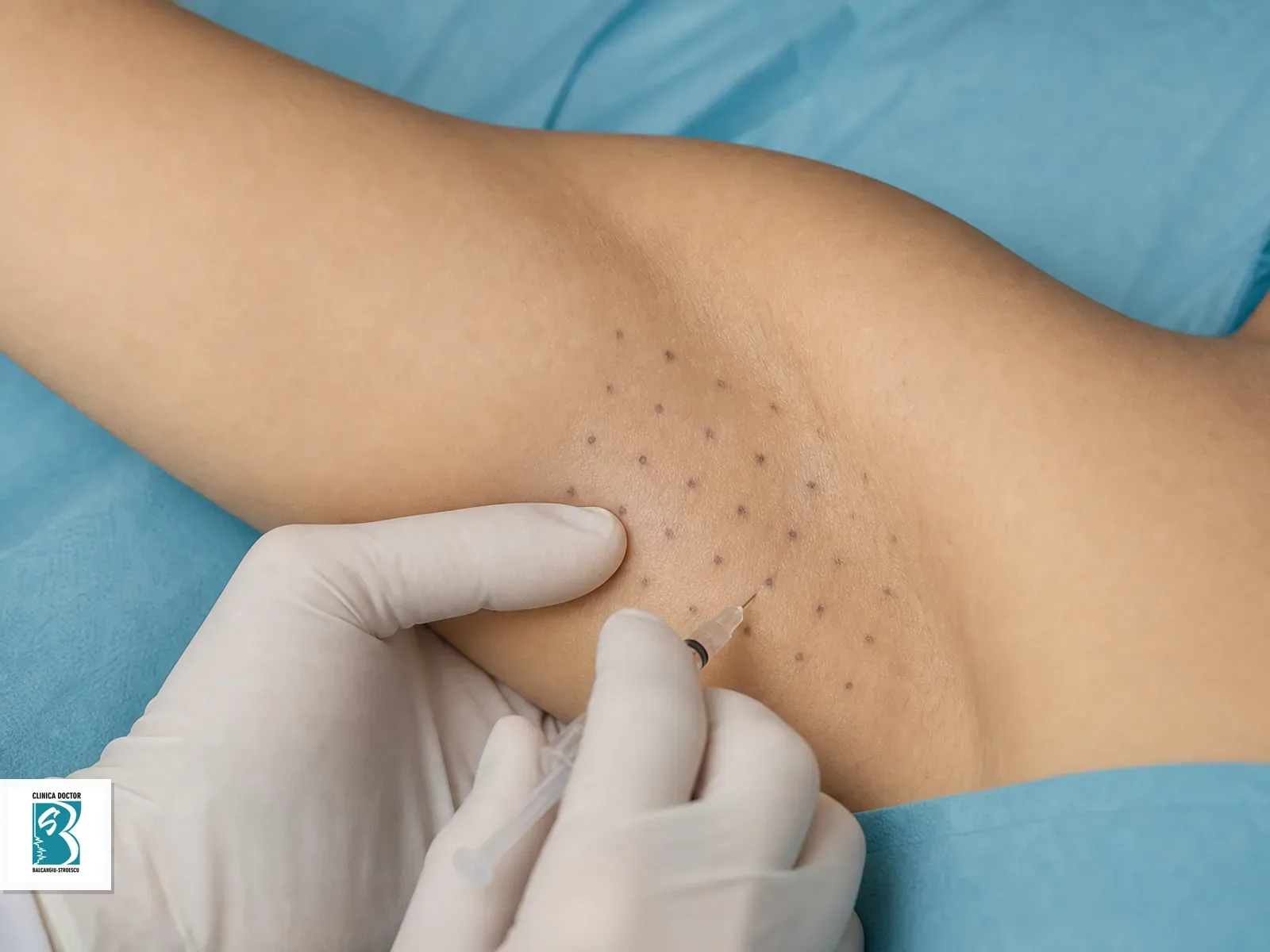 Tratament hiperhidroza axilara Tratament injectabil pentru hiperhidroza axilara pe zona marcata