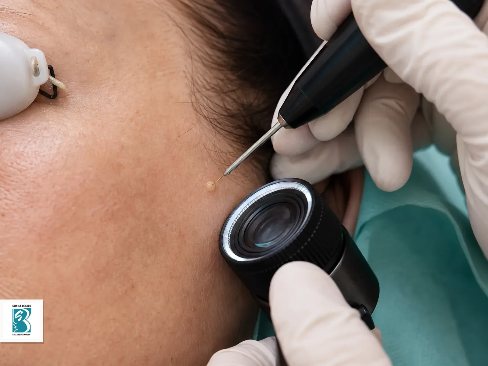 Indepartare hiperplazie de glanda sebacee prin fotovaporizare - 1 leziune Fotovaporizare pentru hiperplazie de glanda sebacee pe obraz