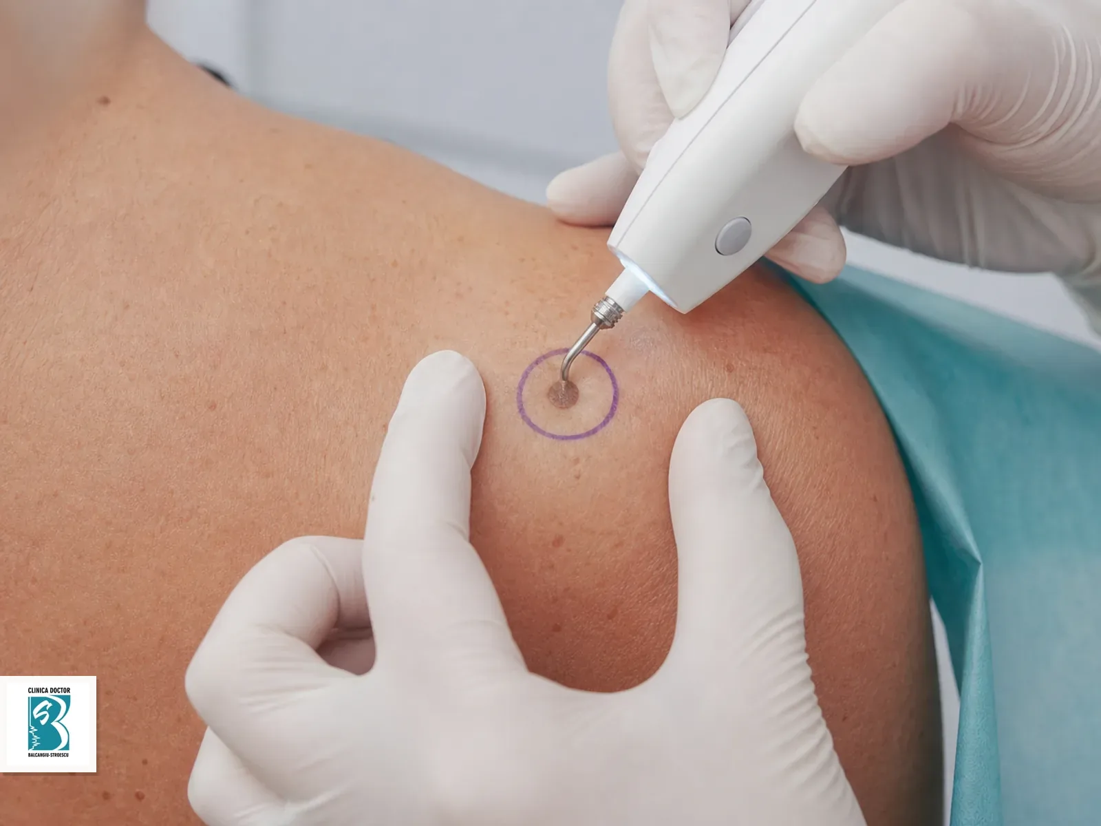 Indepartare keratoza seboreica cu laser / plasma - 1 leziune Indepartare keratoze seboreice cu laser sau plasma, o leziune mica intr-un camp de tratament marcat clinic