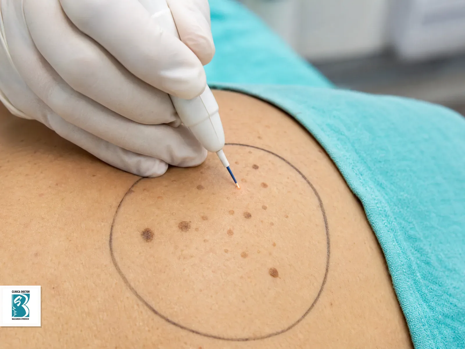 Indepartare keratoze seboreice cu laser / plasma - 10-15 leziuni Indepartare keratoze seboreice cu laser sau plasma, mai multe leziuni mici intr-un camp de tratament marcat clinic