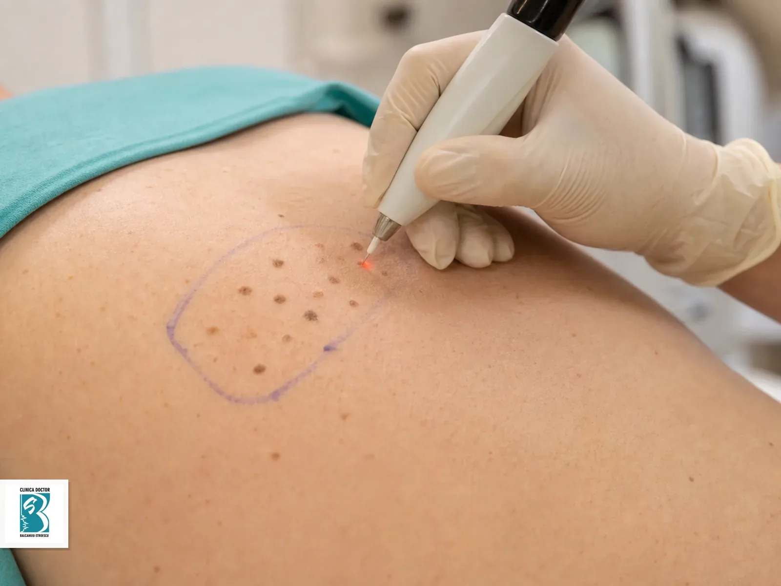 Indepartare keratoze seboreice cu laser / plasma - 6-9 leziuni Indepartare keratoze seboreice cu laser sau plasma, cateva leziuni mici intr-un camp de tratament marcat clinic