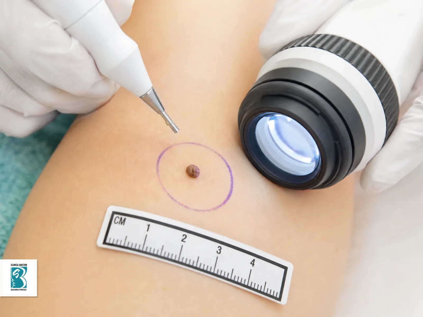 Indepartare nev dermal benign cu laser in cadru clinic