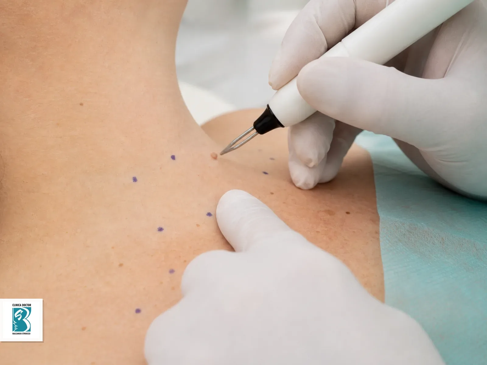 Indepartare papiloame cutanate cu laser CO2 sau plasma, o leziune mica intr-un camp de tratament marcat clinic