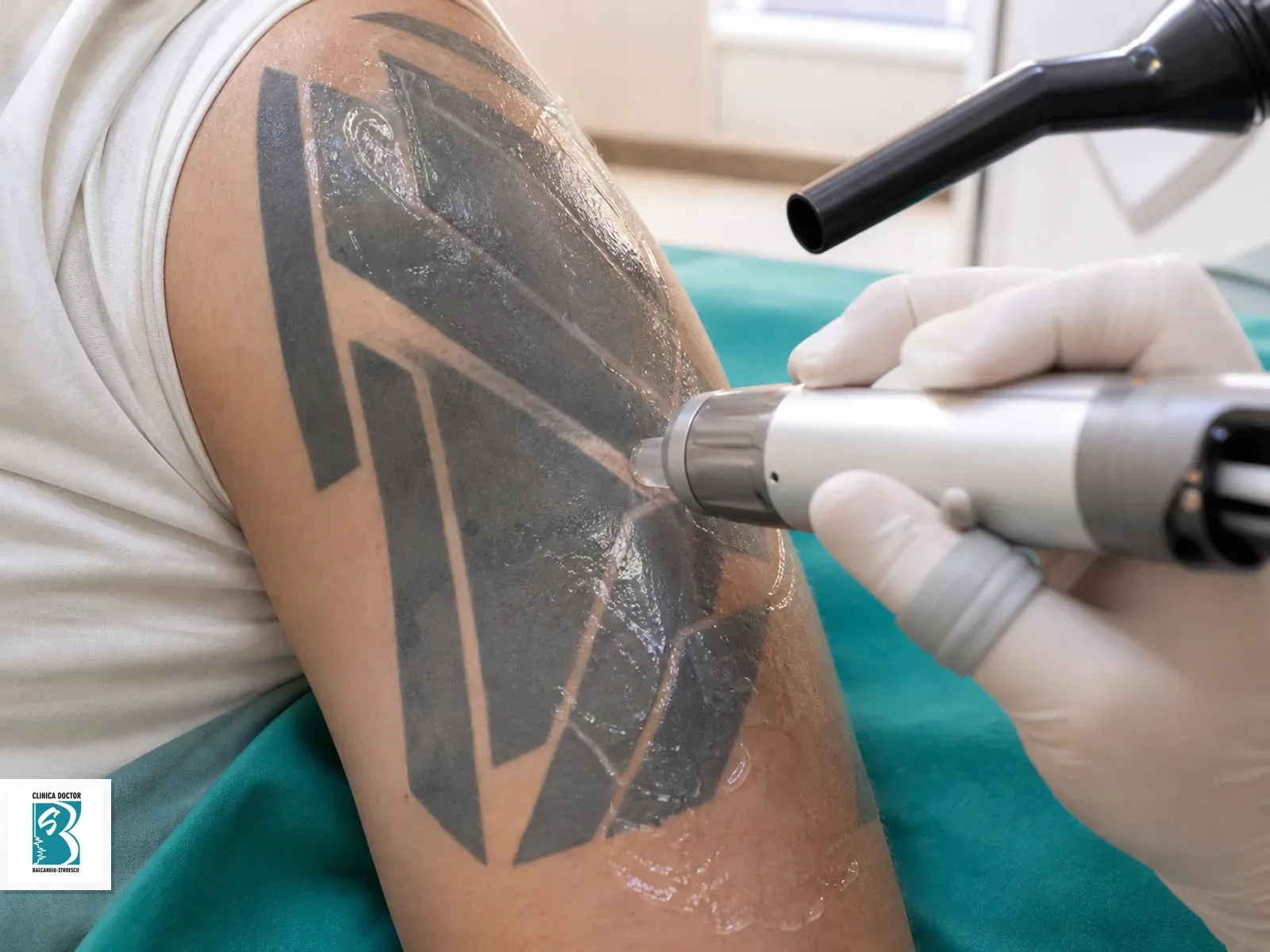 Indepartare tatuaj mare - laser ClearLift QS Nd:YAG 1064 nm Indepartare tatuaj mare cu laser QS Nd:YAG pe piele