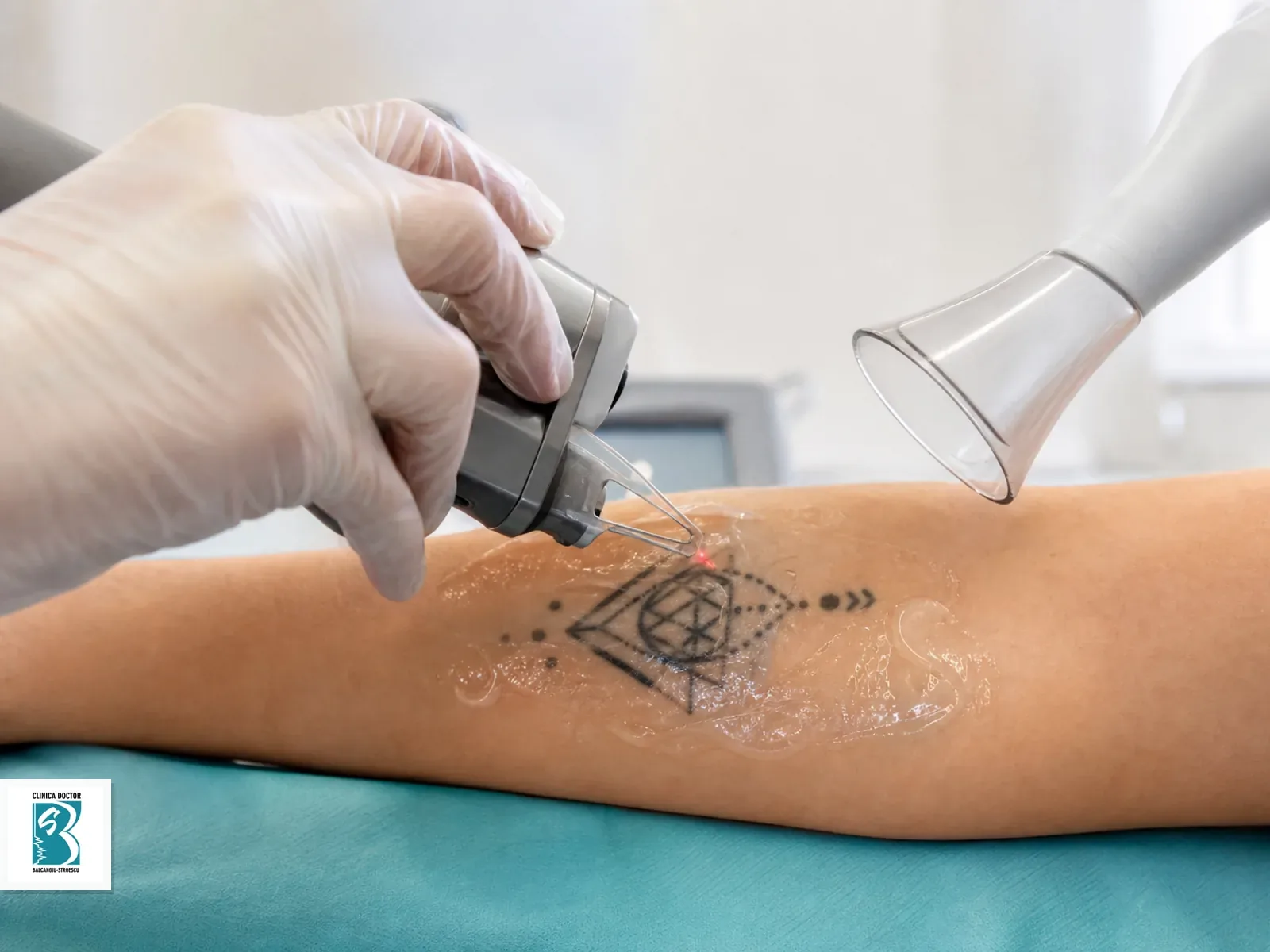 Indepartare tatuaj mediu - laser ClearLift QS Nd:YAG 1064 nm Indepartare tatuaj mediu cu laser QS Nd:YAG pe piele