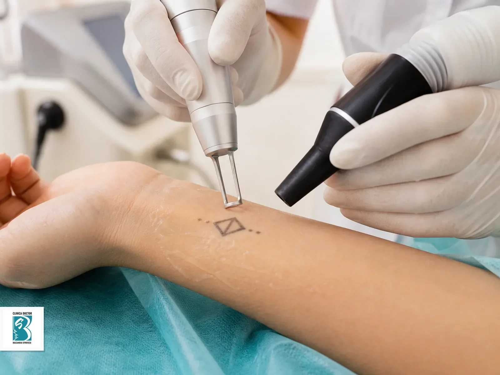 Indepartare tatuaj mic - laser ClearLift QS Nd:YAG 1064 nm Indepartare tatuaj mic cu laser QS Nd:YAG pe piele