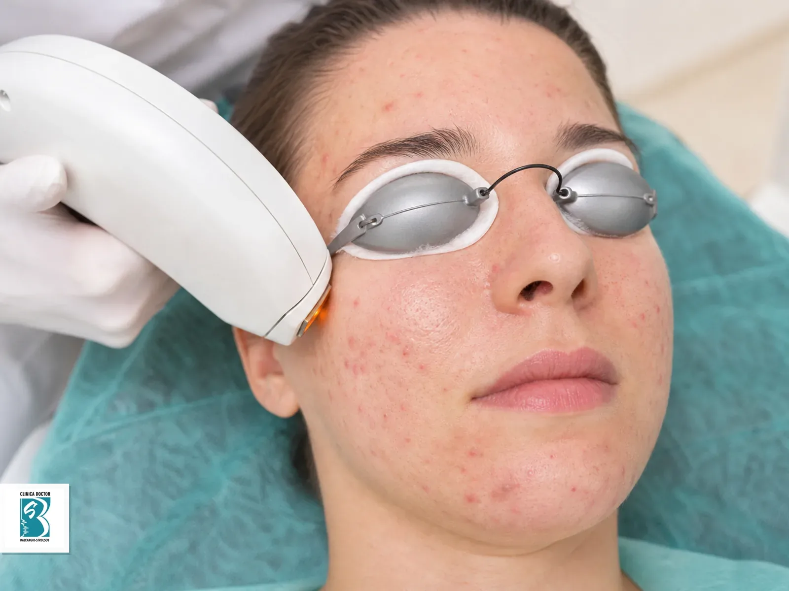 IPL Acne Clear - Acnee Activa, Ten Seboreic, Pori Dilatati - fata integral Tratament IPL Acne Clear pentru intregii fete, cu acnee activa si pori dilatati