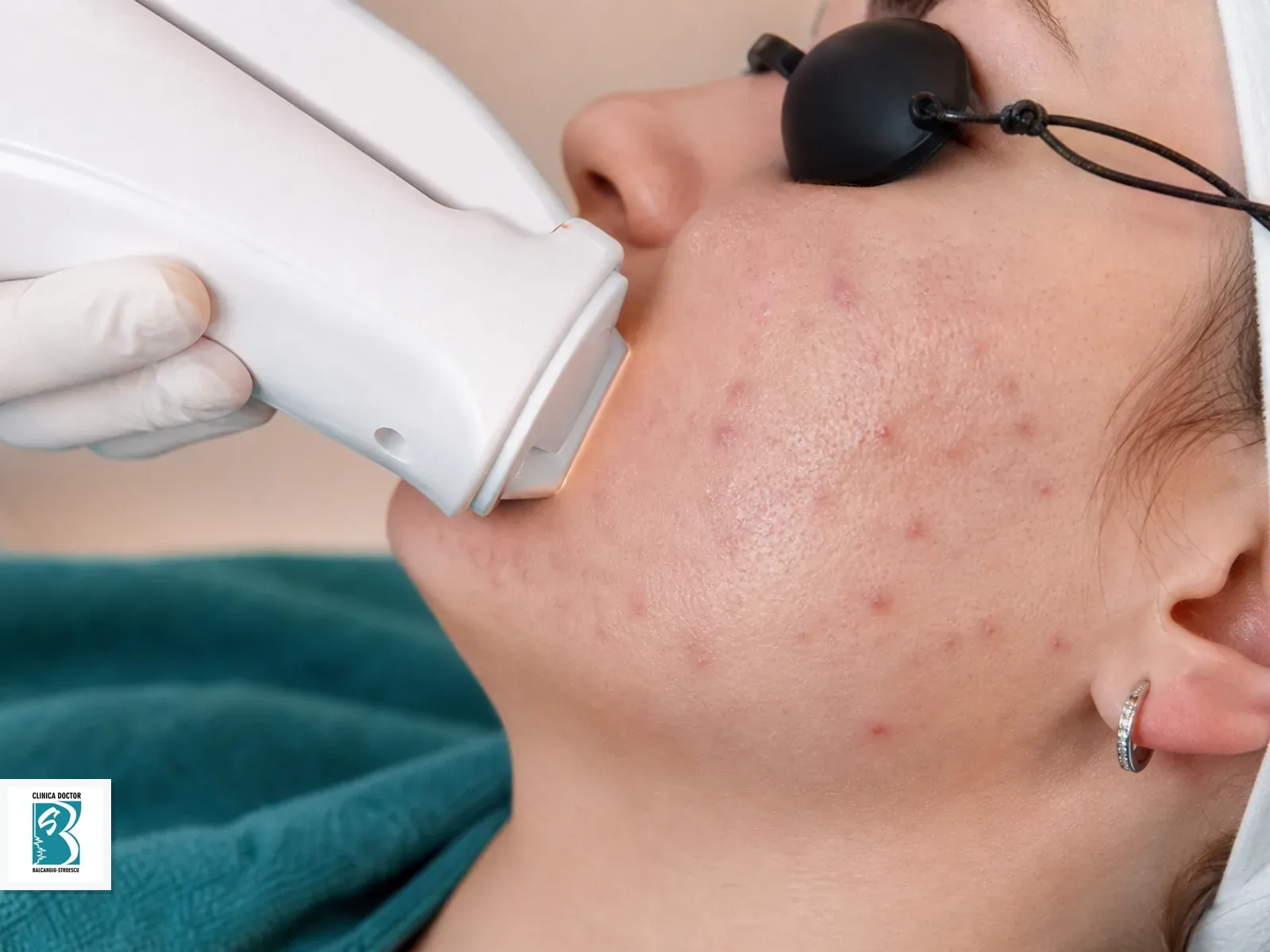 IPL Acne Clear - Acnee Activa, Ten Seboreic, Pori Dilatati - obraji/ zona localizata Tratament IPL Acne Clear pentru obrajilor si pometilor, cu acnee activa si pori dilatati