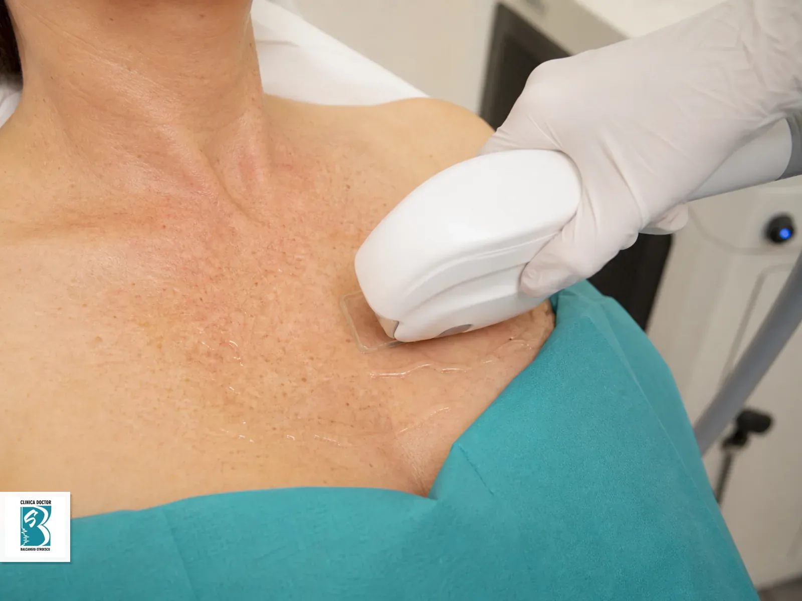 IPL Tight & Bright - Hiperpigmentari, Pete Pigmentare, Luminozitate - decolteu Tratament IPL Tight & Bright pentru decolteului, cu pete pigmentare evaluate in cadru clinic