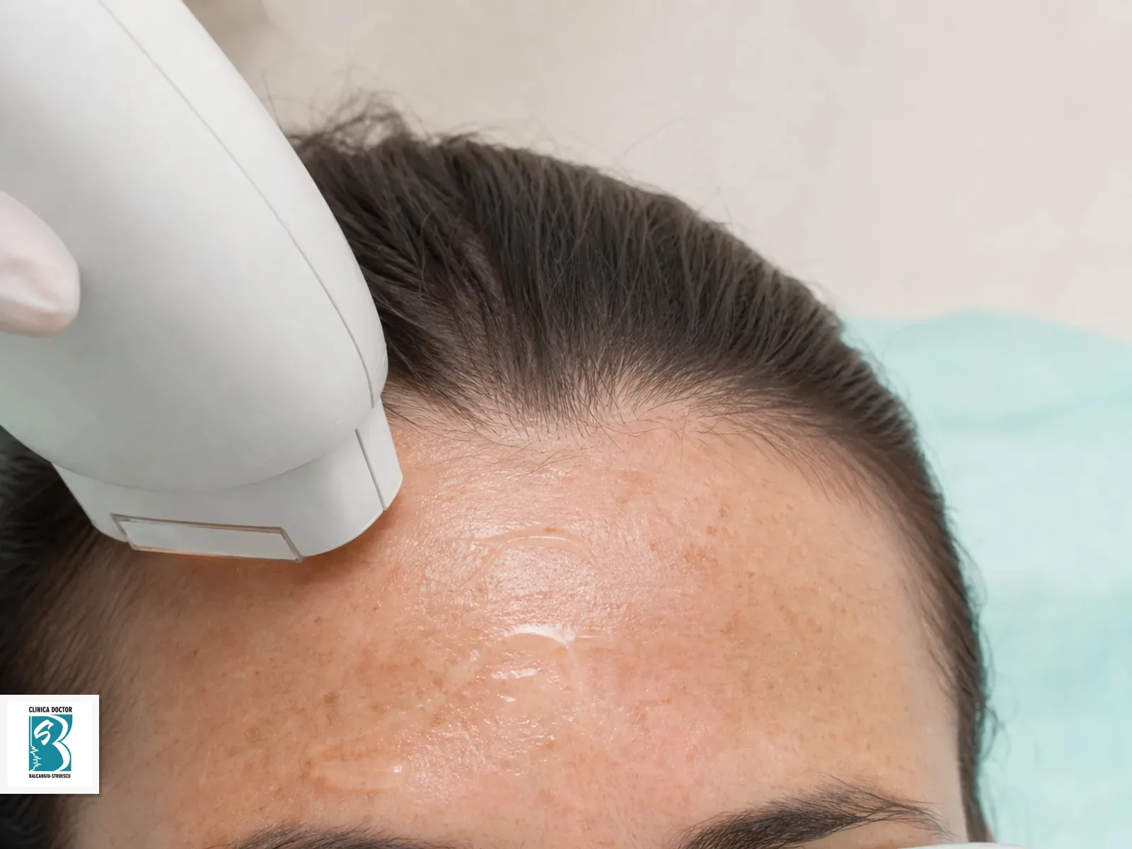 IPL Tight & Bright - Hiperpigmentari, Pete Pigmentare, Luminozitate - frunte Tratament IPL Tight & Bright pentru fruntii, cu pete pigmentare evaluate in cadru clinic